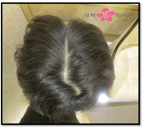 치료 전 사진입니다.